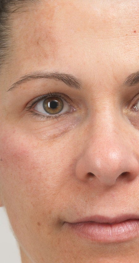 Cheek area before four sessions of Advanced Pigment Control