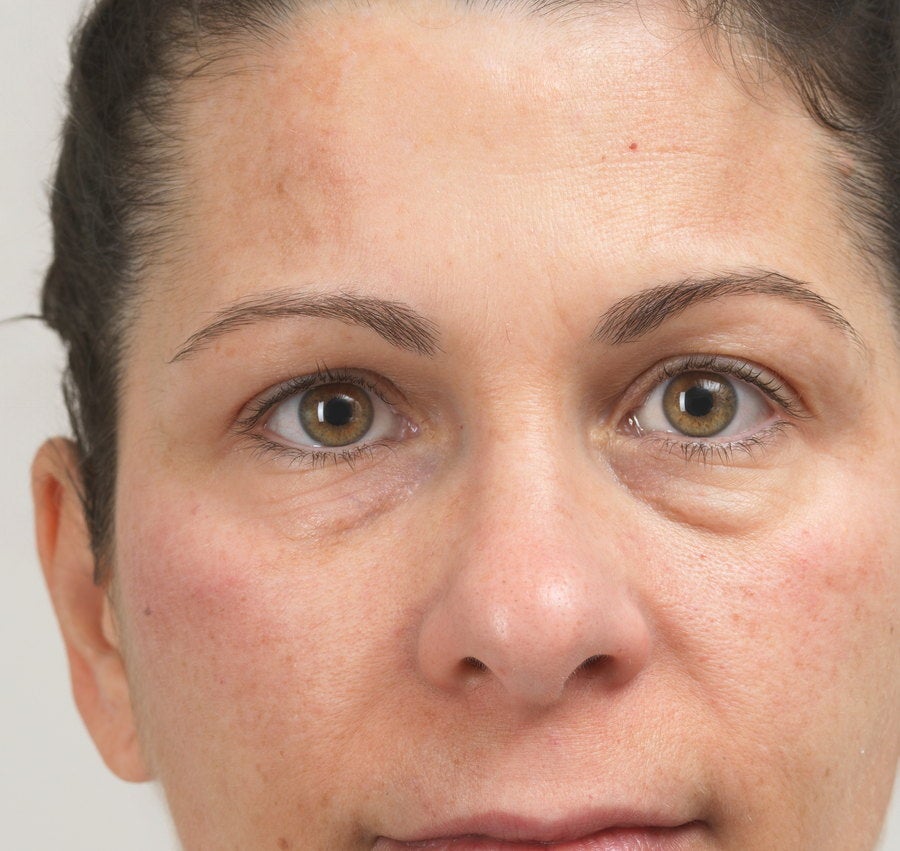 Cheek area before four sessions of Advanced Pigment Control