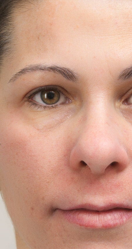 The same cheek area after four sessions of Advanced Pigment Control