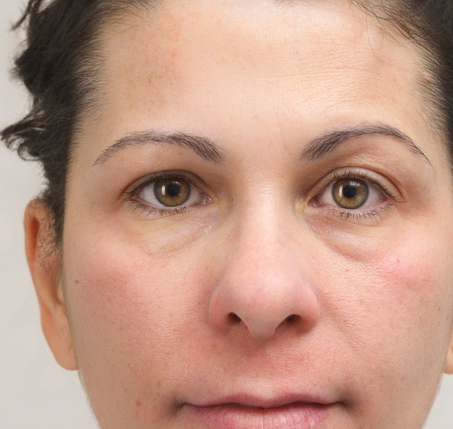 The same cheek area after four sessions of Advanced Pigment Control