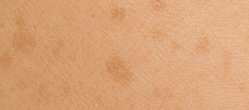 Detalle de piel con manchas oscuras