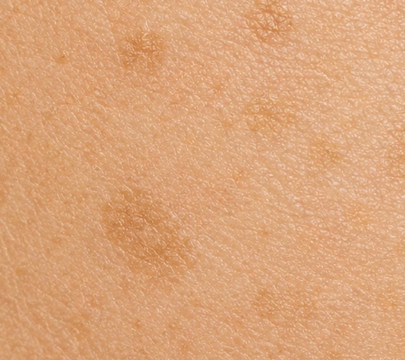 Detalle de piel con manchas oscuras