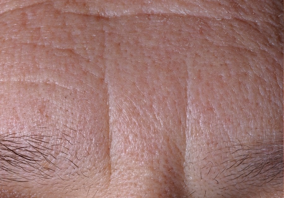 Forehead before the treatment