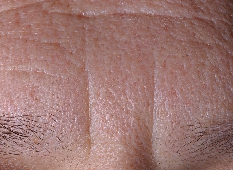 Forehead before the treatment