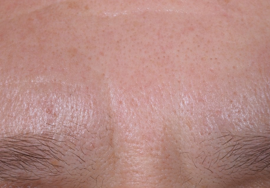Forehead after the treatment