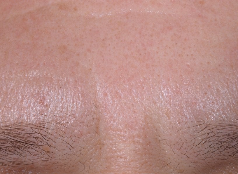 Forehead after the treatment