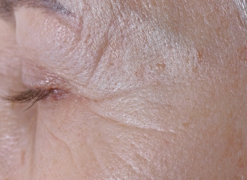 Eye contour before the treatment