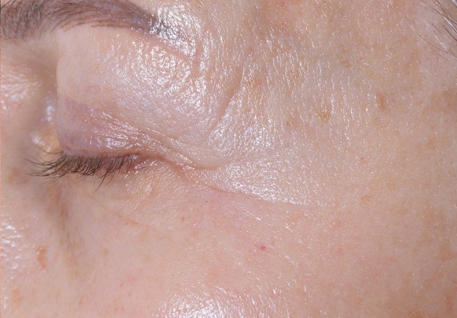 Eye contour after the treatment
