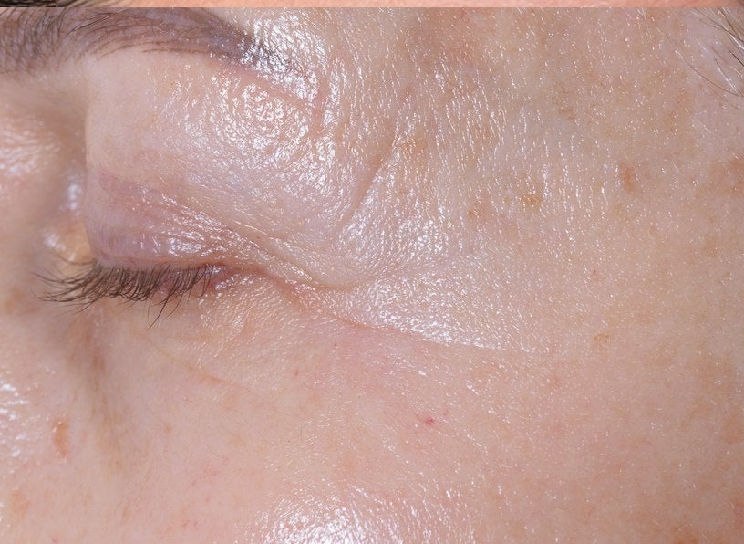 Eye contour after the treatment